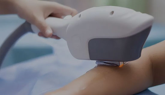Depilação a laser de diodo