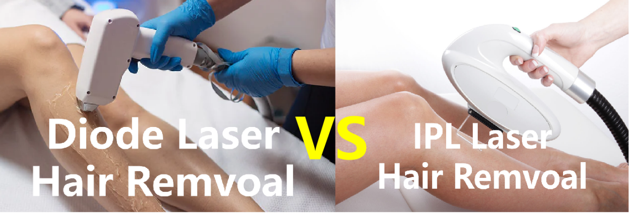 REMOÇÃO DE PÊLOS IPL VS LASER DE DIODO