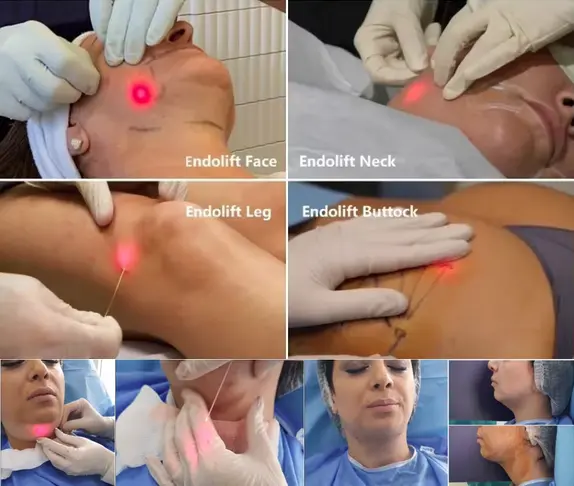 980nm 1470nmdiode Laser Lipolysis Machine